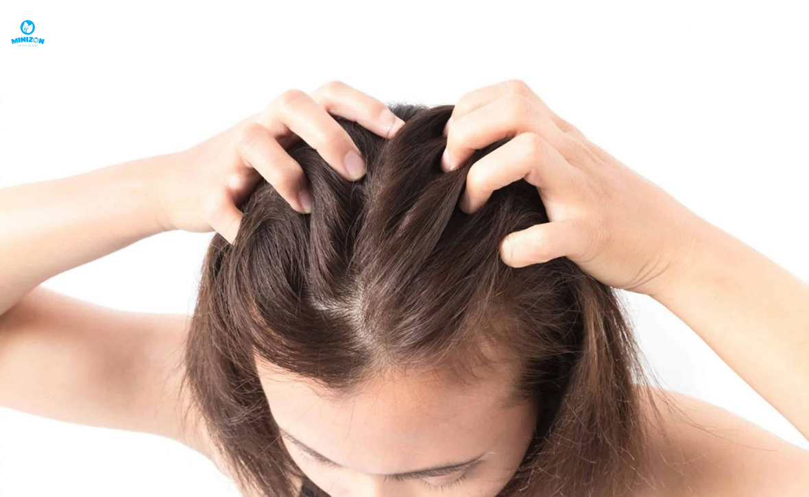 Giảm căng thẳng, lo lắng tránh rụng tóc sau sinh Giảm căng thẳng, lo lắng tránh rụng tóc sau sinh