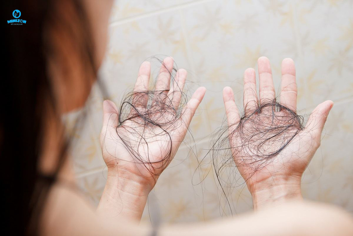 Thiếu máu – thiếu sắt gây rụng tóc sau sinh Thiếu máu – thiếu sắt gây rụng tóc sau sinh