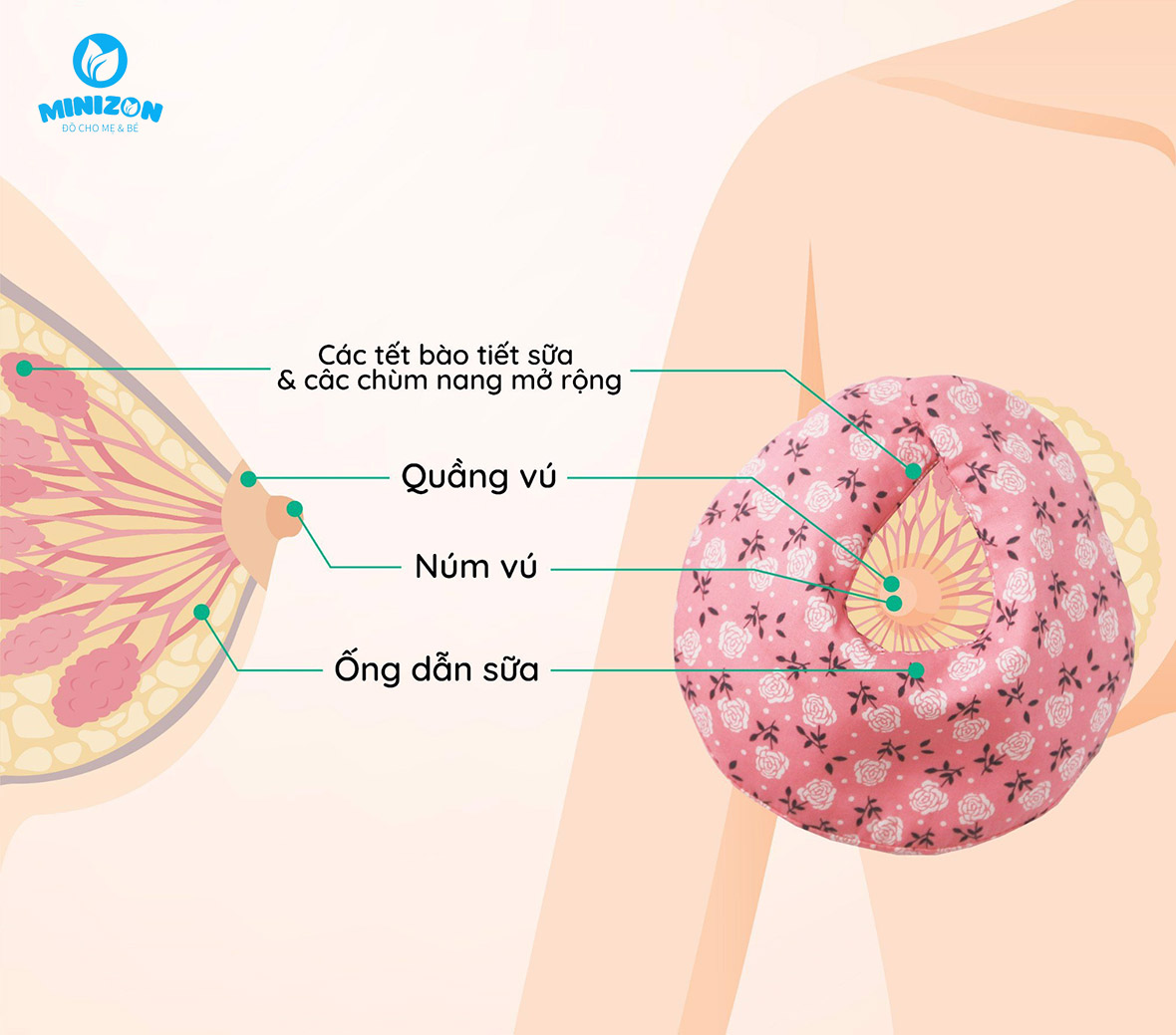 Tắc tia sữa do viêm nhiễm Tắc tia sữa do viêm nhiễm