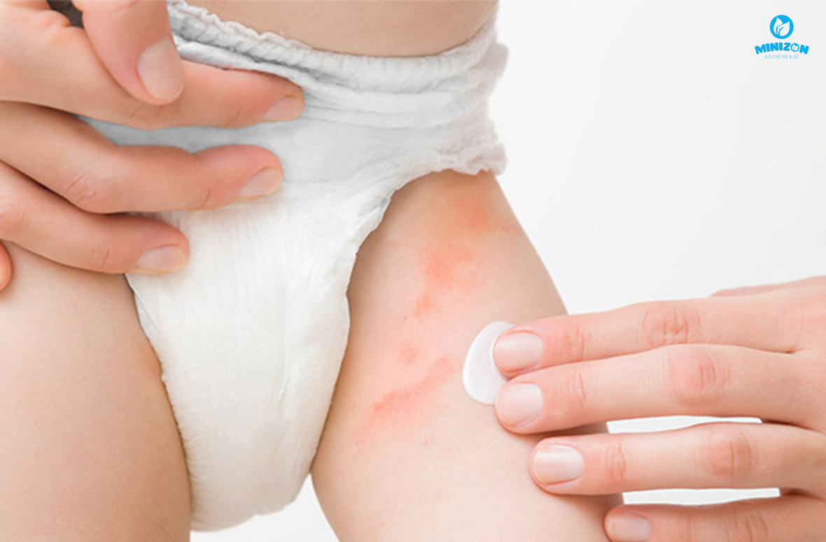 Tắm rửa hằng ngày giúp trị hăm Tắm rửa hằng ngày giúp trị hăm