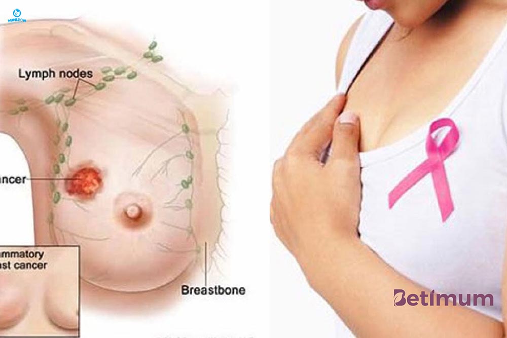 Tắc tia sữa Tắc tia sữa