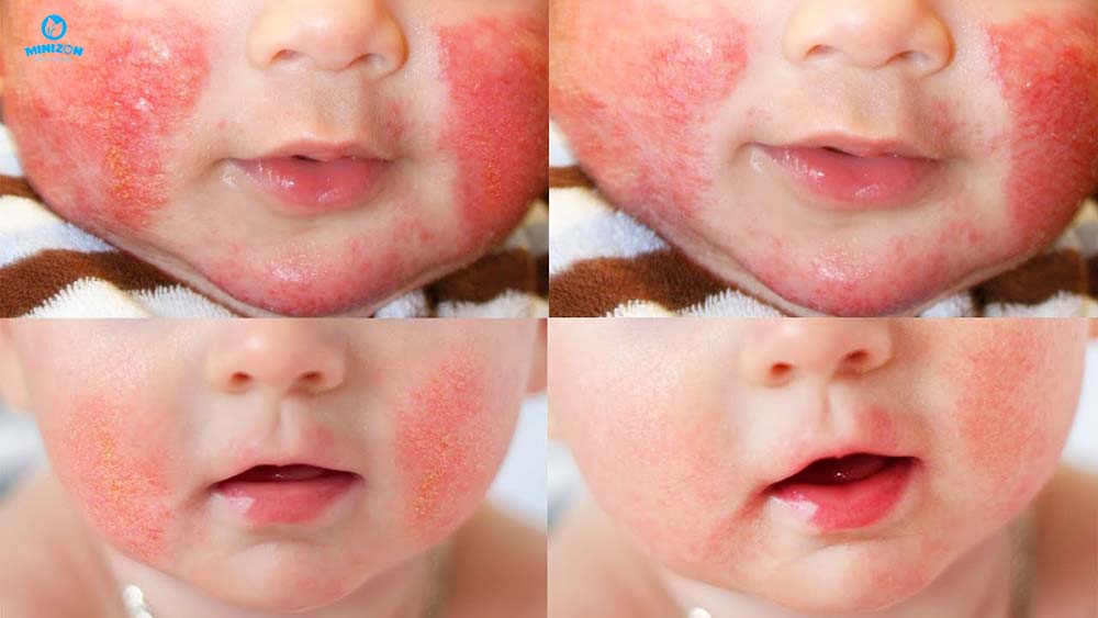 Chàm Eczema Chàm Eczema